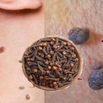 Baking Soda: A Natural Way to Tackle Age Spots, Acne, and Blackheads