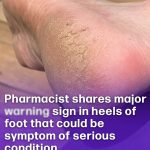 The Powerful Medicinal Benefits and Uses of Senna alata